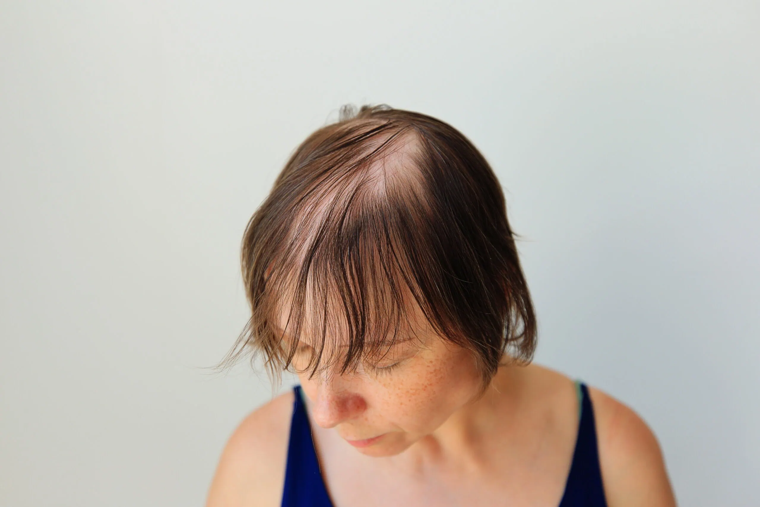 Hair Loss In The Form Of Alopecia Areata.