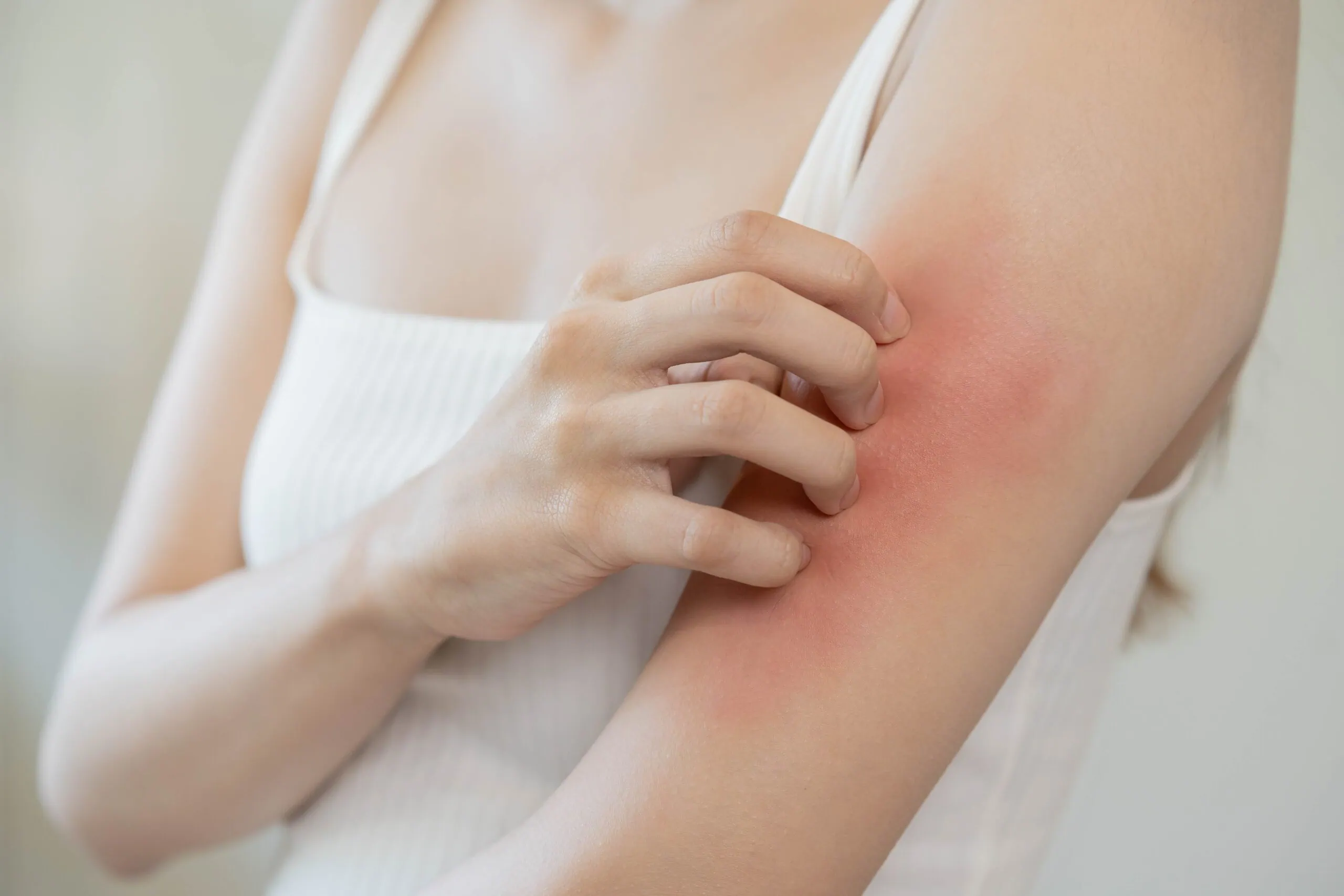 Dermatology,,asian,young,woman,,girl,allergy,,allergic,reaction,from,atopic,